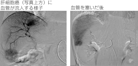 肝細胞癌（写真上方）に血管が流入する様子　血管を塞いだ後