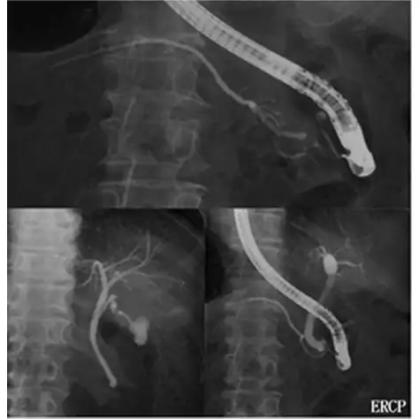 ERCP