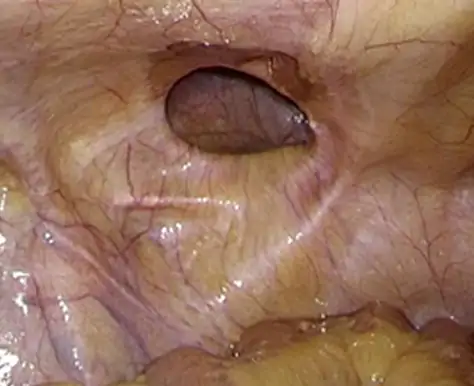 お腹の中から見たヘルニアの穴