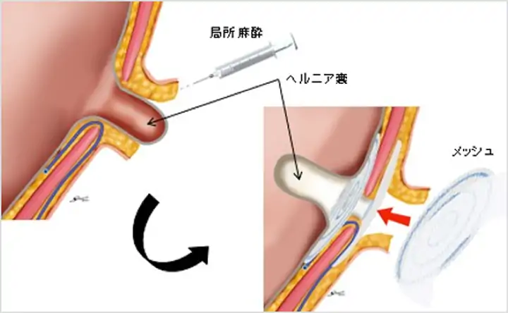 そけい部切開法イメージ1