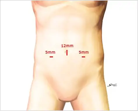 腹腔鏡手術の短所