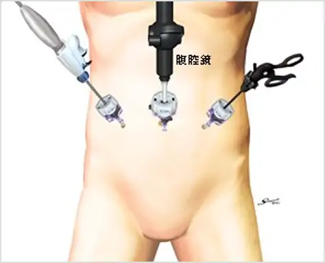 腹腔鏡手術の短所