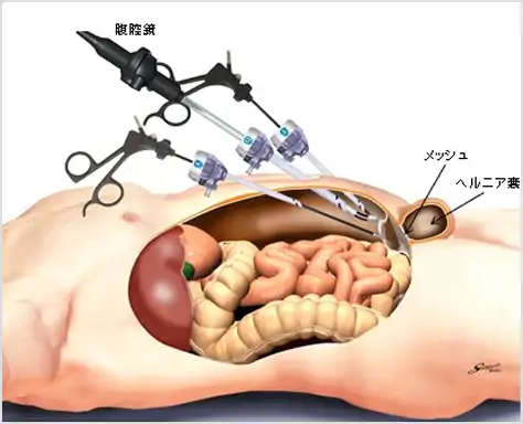 腹腔鏡手術の短所