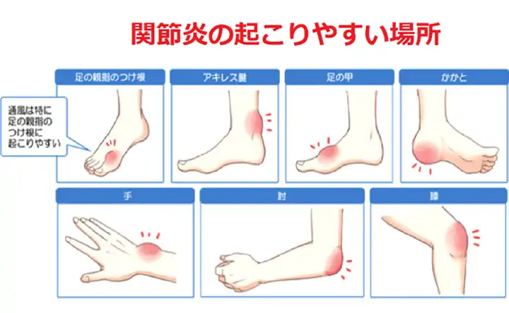 関節炎の起こりやすい場所